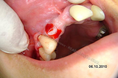 Reparem no corte...bonitinho mas fiquei com raiva depois. rsrsrs. Caramba, por que que eu tinha que tirar esta gengiva dali? Era só enrolar o excesso para a vestibular e conseguiria um bom aumento de volume gengival, o que ajudaria bastante na estética periimplantar. Mas tudo bem, vou fazer a cirurgia periodontal depois para corrigir isto sem cobrar da paciente, só de raiva. hehehe. Tem que rir para não chorar.