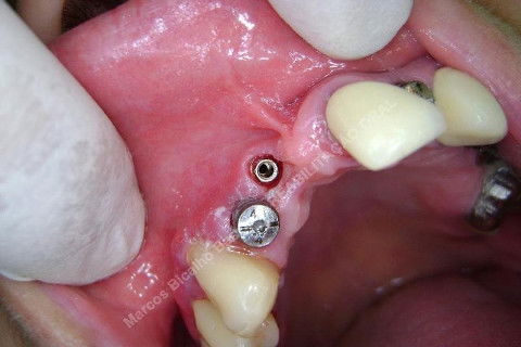 Vai faltar gengiva depois, com certeza.