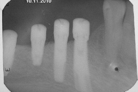 Reabiltiação Oral - 10 Implantes Maxila e Mandíbula - Parte Iv - Reabertura e Instalação dos Cicatrizadores