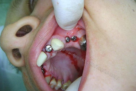 Reabiltiação Oral - 10 Implantes Maxila e Mandíbula - Parte Iv - Reabertura e Instalação dos Cicatrizadores