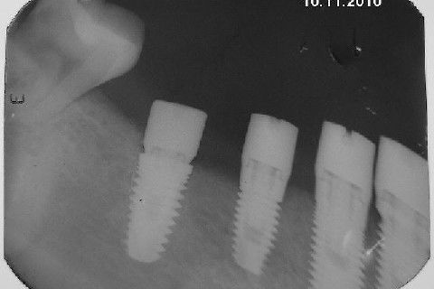 Reabiltiação Oral - 10 Implantes Maxila e Mandíbula - Parte Iv - Reabertura e Instalação dos Cicatrizadores