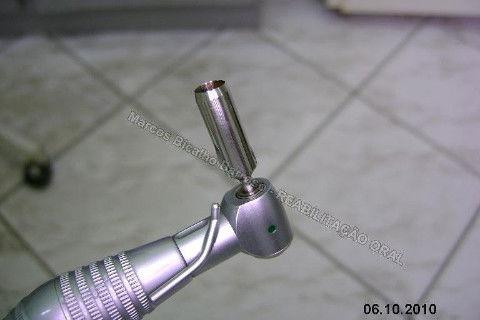 Iniciei esta etapa com o uso de um bisturi circular para contra ângulo. Na verdade, estou postando novamente este procedimento, mas realmente, cheguei depois a conclusão que não deveria ter agido assim nos dentes anteriores, onde a estética é primordial, não devemos remover tecido mole, mas manipular para promover um aumento de papila. Este bisturi é útil para dentes posteriores, adianta bastante o trabalho, é rápido, remove uma porção do formato e dimensão da plataforma do implante, a conta para adaptação do cicatrizador.