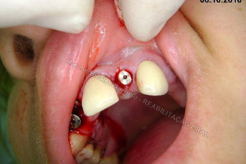 Reabiltiação Oral - 10 Implantes Maxila e Mandíbula - Parte Iv - Reabertura e Instalação dos Cicatrizadores