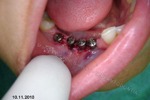 Reabiltiação Oral - 10 Implantes Maxila e Mandíbula - Parte Iv - Reabertura e Instalação dos Cicatrizadores