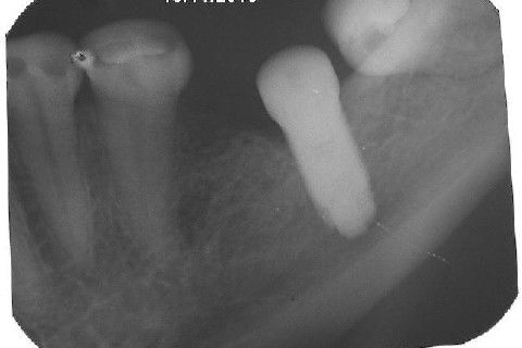 Reabiltiação Oral - 10 Implantes Maxila e Mandíbula - Parte Iv - Reabertura e Instalação dos Cicatrizadores