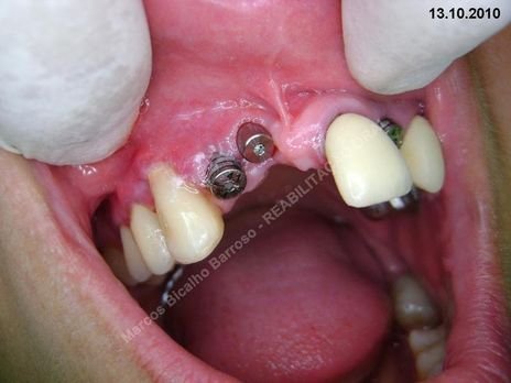 Reabiltiação Oral - 10 Implantes Maxila e Mandíbula - Parte Iv - Reabertura e Instalação dos Cicatrizadores