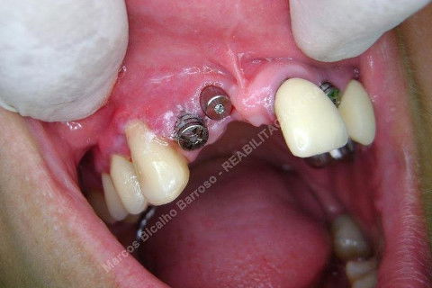 Reabiltiação Oral - 10 Implantes Maxila e Mandíbula - Parte Iv - Reabertura e Instalação dos Cicatrizadores