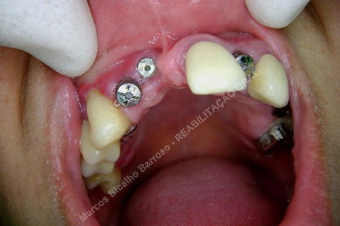 Reabiltiação Oral - 10 Implantes Maxila e Mandíbula - Parte Iv - Reabertura e Instalação dos Cicatrizadores