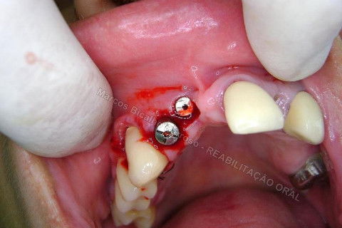 Reabiltiação Oral - 10 Implantes Maxila e Mandíbula - Parte Iv - Reabertura e Instalação dos Cicatrizadores