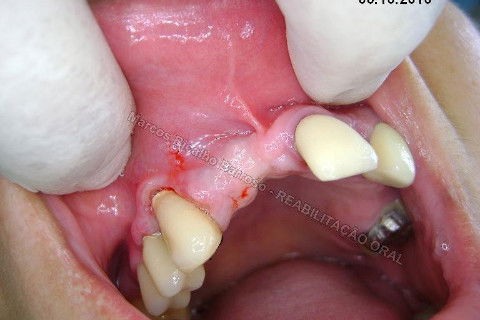 Reabiltiação Oral - 10 Implantes Maxila e Mandíbula - Parte Iv - Reabertura e Instalação dos Cicatrizadores