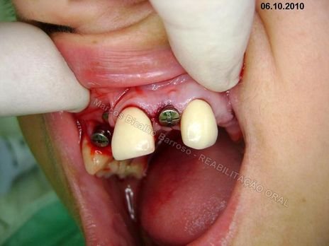 Reabiltiação Oral - 10 Implantes Maxila e Mandíbula - Parte Iv - Reabertura e Instalação dos Cicatrizadores