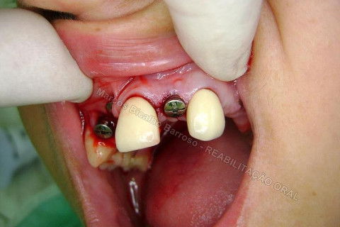 Reabiltiação Oral - 10 Implantes Maxila e Mandíbula - Parte Iv - Reabertura e Instalação dos Cicatrizadores