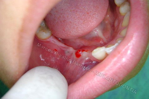 Reabiltiação Oral - 10 Implantes Maxila e Mandíbula - Parte Iv - Reabertura e Instalação dos Cicatrizadores