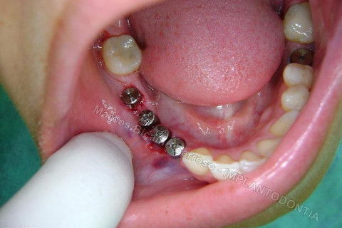 Reabiltiação Oral - 10 Implantes Maxila e Mandíbula - Parte Iv - Reabertura e Instalação dos Cicatrizadores