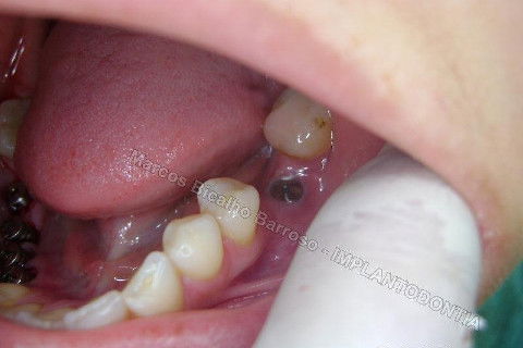 Reabiltiação Oral - 10 Implantes Maxila e Mandíbula - Parte Iv - Reabertura e Instalação dos Cicatrizadores