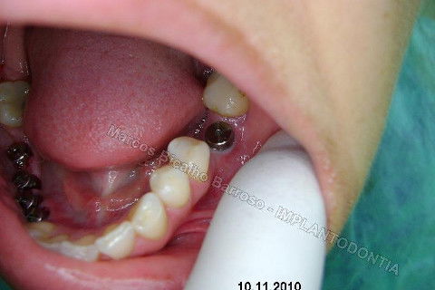 Reabiltiação Oral - 10 Implantes Maxila e Mandíbula - Parte Iv - Reabertura e Instalação dos Cicatrizadores