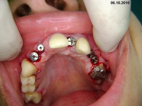 Reabiltiação Oral - 10 Implantes Maxila e Mandíbula - Parte Iv - Reabertura e Instalação dos Cicatrizadores