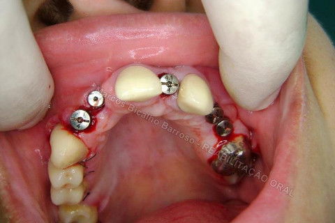 Reabiltiação Oral - 10 Implantes Maxila e Mandíbula - Parte Iv - Reabertura e Instalação dos Cicatrizadores