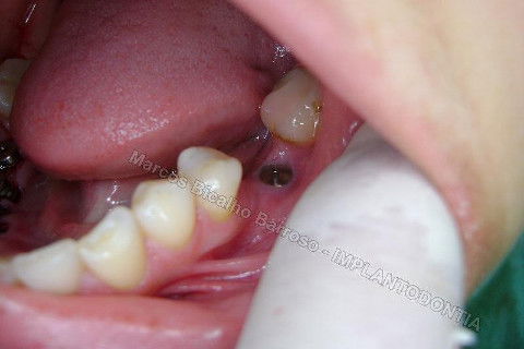 Reabiltiação Oral - 10 Implantes Maxila e Mandíbula - Parte Iv - Reabertura e Instalação dos Cicatrizadores