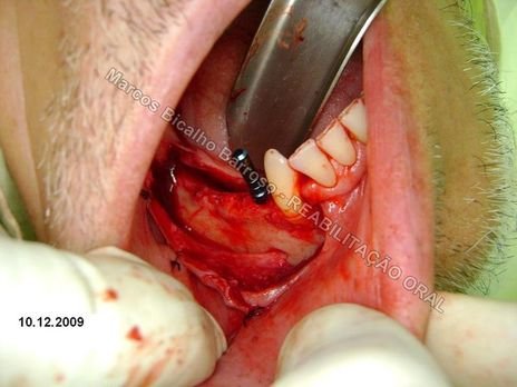 Exposição do mentoniano, para melhor visualização do seu posicionamento e consequentemente planejamento do comprimento do implante durante a cirurgia.