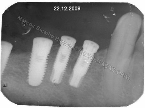 Planejamento Reverso em Implantodontia - Parte Iii - Instalação de 4 Implantes - 44,45,46,47