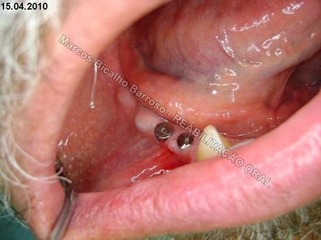 Planejamento Reverso em Implantodontia - Parte Iii - Instalação de 4 Implantes - 44,45,46,47