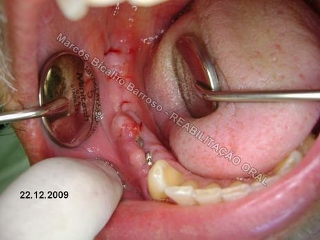 Planejamento Reverso em Implantodontia - Parte Iii - Instalação de 4 Implantes - 44,45,46,47