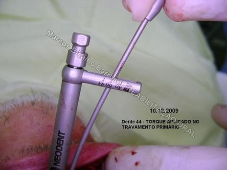 Planejamento Reverso em Implantodontia - Parte Iii - Instalação de 4 Implantes - 44,45,46,47