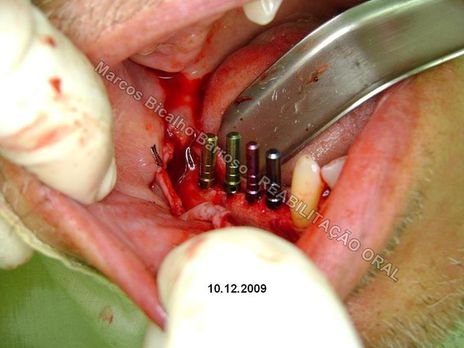 Planejamento Reverso em Implantodontia - Parte Iii - Instalação de 4 Implantes - 44,45,46,47