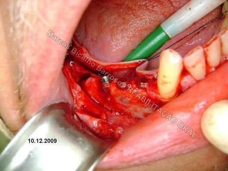 Planejamento Reverso em Implantodontia - Parte Iii - Instalação de 4 Implantes - 44,45,46,47