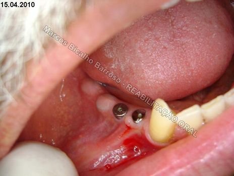 Planejamento Reverso em Implantodontia - Parte Iii - Instalação de 4 Implantes - 44,45,46,47