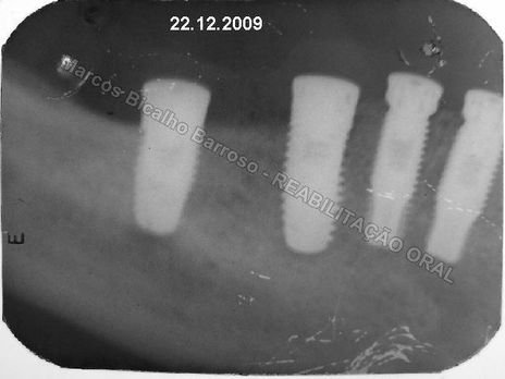 Planejamento Reverso em Implantodontia - Parte Iii - Instalação de 4 Implantes - 44,45,46,47