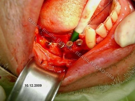 Planejamento Reverso em Implantodontia - Parte Iii - Instalação de 4 Implantes - 44,45,46,47