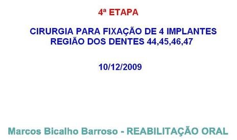 Planejamento Reverso em Implantodontia - Parte Iii - Instalação de 4 Implantes - 44,45,46,47