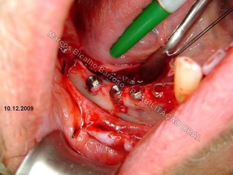 Planejamento Reverso em Implantodontia - Parte Iii - Instalação de 4 Implantes - 44,45,46,47