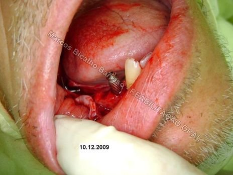 Planejamento Reverso em Implantodontia - Parte Iii - Instalação de 4 Implantes - 44,45,46,47