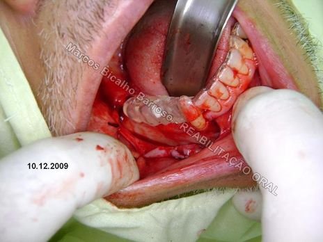 Planejamento Reverso em Implantodontia - Parte Iii - Instalação de 4 Implantes - 44,45,46,47