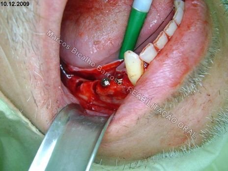 Planejamento Reverso em Implantodontia - Parte Iii - Instalação de 4 Implantes - 44,45,46,47