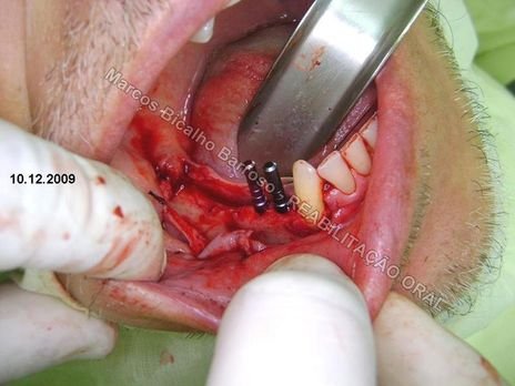 Planejamento Reverso em Implantodontia - Parte Iii - Instalação de 4 Implantes - 44,45,46,47