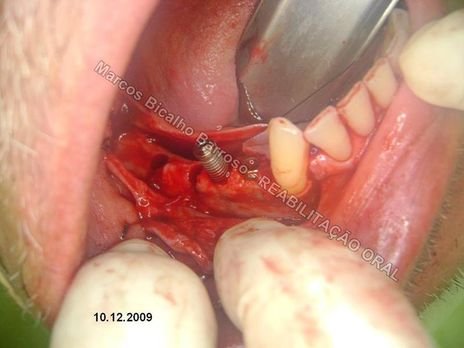 Planejamento Reverso em Implantodontia - Parte Iii - Instalação de 4 Implantes - 44,45,46,47