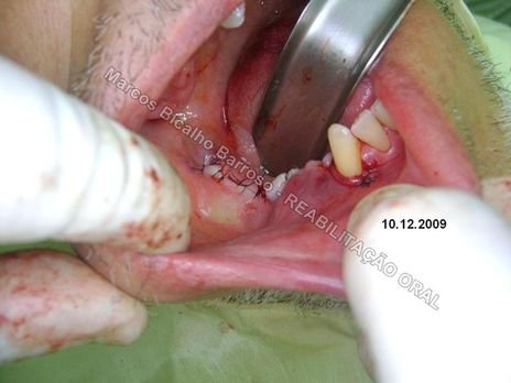 Planejamento Reverso em Implantodontia - Parte Iii - Instalação de 4 Implantes - 44,45,46,47