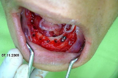 Protocolo Inferior com 5 Implantes - Parte I - Planejamento + Cirurgia