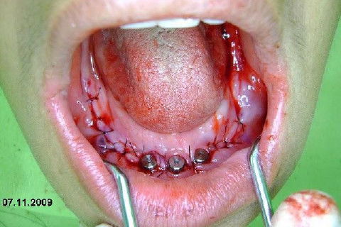 Protocolo Inferior com 5 Implantes - Parte I - Planejamento + Cirurgia