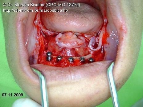 Protocolo Inferior com 5 Implantes - Parte I - Planejamento + Cirurgia