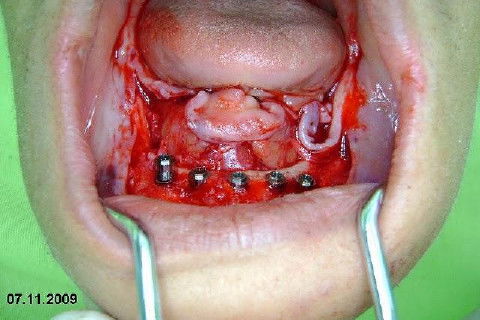 Protocolo Inferior com 5 Implantes - Parte I - Planejamento + Cirurgia