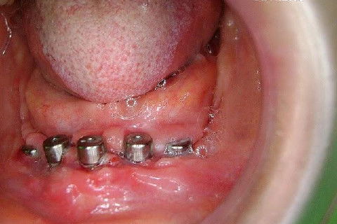 Protocolo Inferior com 5 Implantes - Parte I - Planejamento + Cirurgia