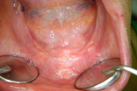 Protocolo Inferior com 5 Implantes - Parte I - Planejamento + Cirurgia