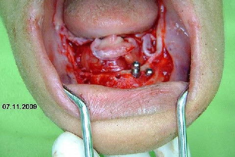 Protocolo Inferior com 5 Implantes - Parte I - Planejamento + Cirurgia
