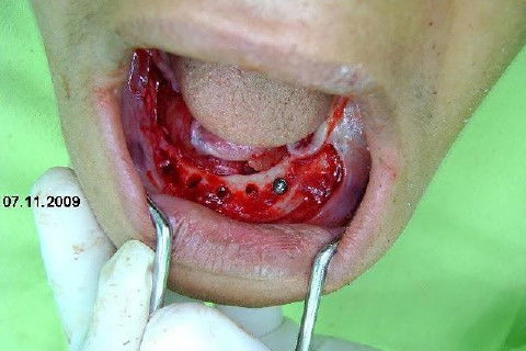 Protocolo Inferior com 5 Implantes - Parte I - Planejamento + Cirurgia