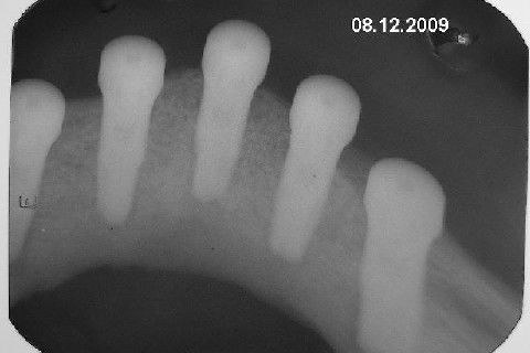 Protocolo Inferior com 5 Implantes - Parte I - Planejamento + Cirurgia